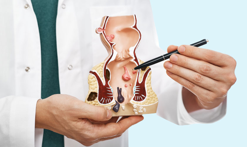 Ayurvedic Treatment of Anal Fissures