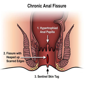 Anal Fissures