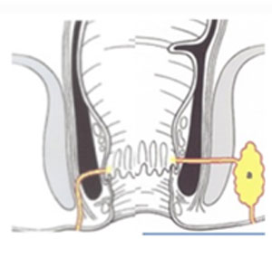 fistula-treatment-in-hyderabad