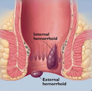 Hemorrhoids