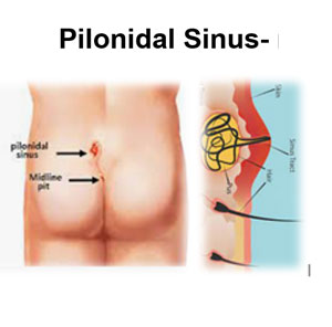 Pilonidal Sinus
